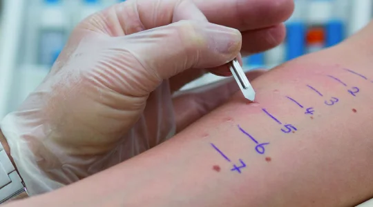 Dia Mundial da Alergia