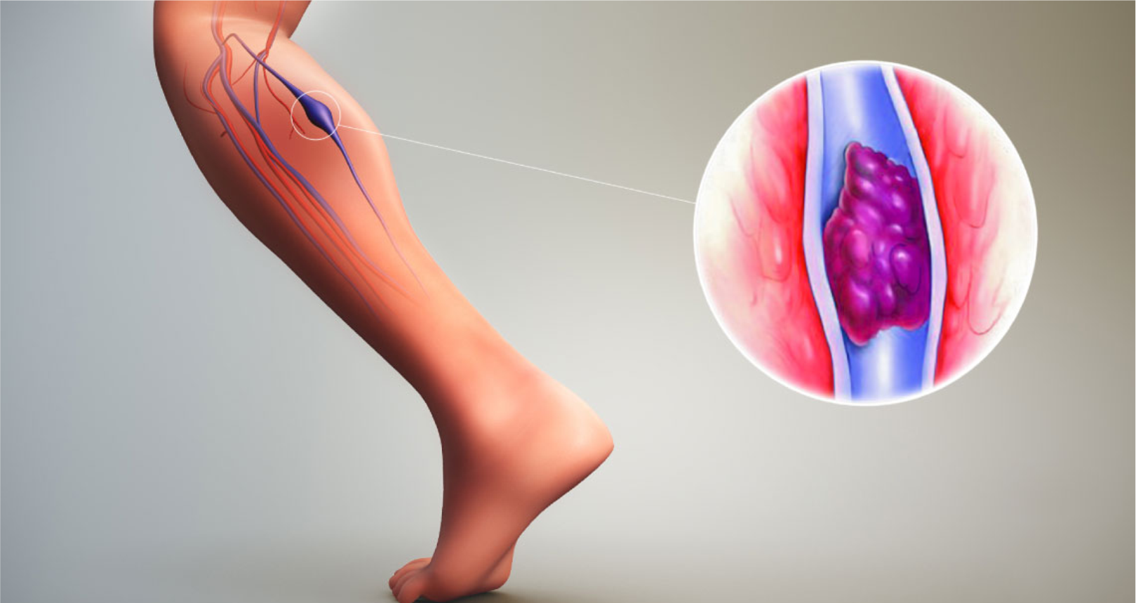 Dia Mundial da Trombose: prevenção e conscientização salvam vidas