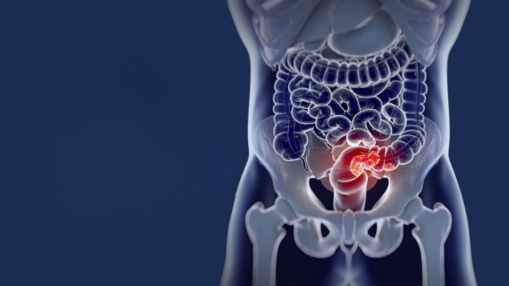 Dia Nacional de Combate ao Câncer Colorretal