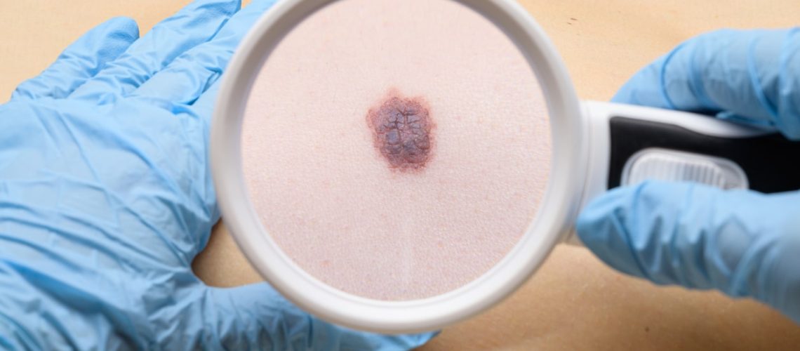 Dia Global de Conscientização sobre o Câncer de Pele Não Melanoma